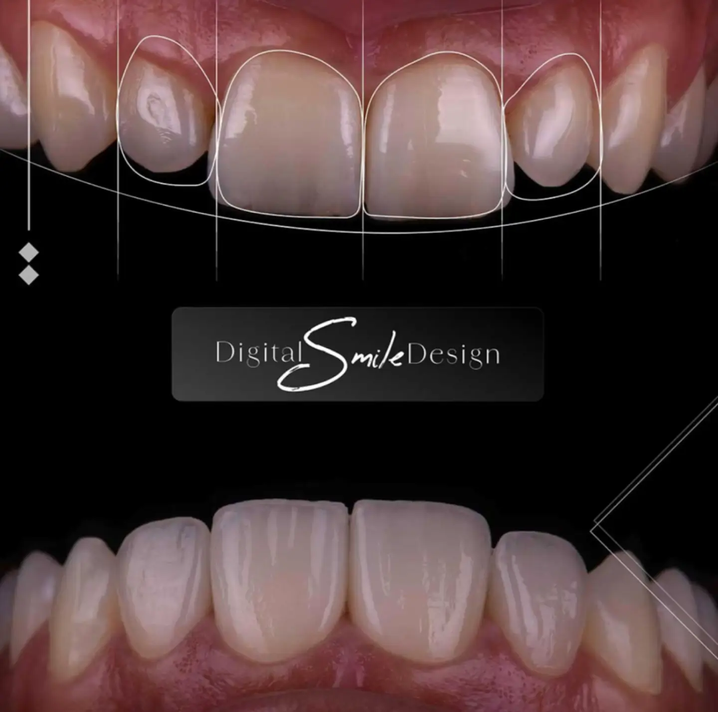 add starlite logo veneers image (1)