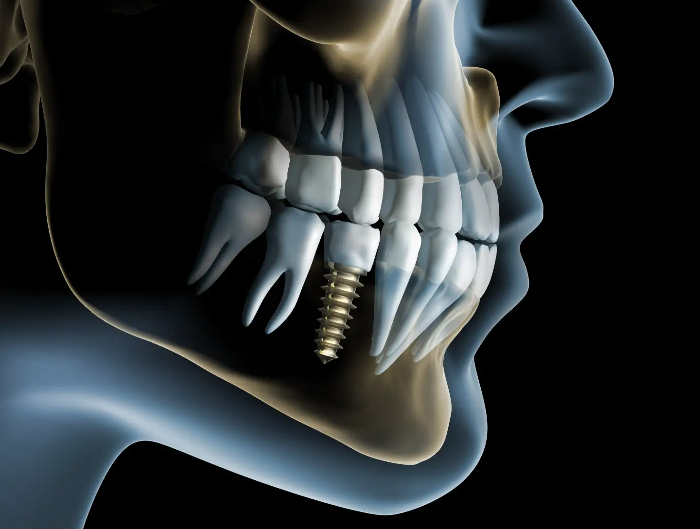 implant istock 1158385804 (1)