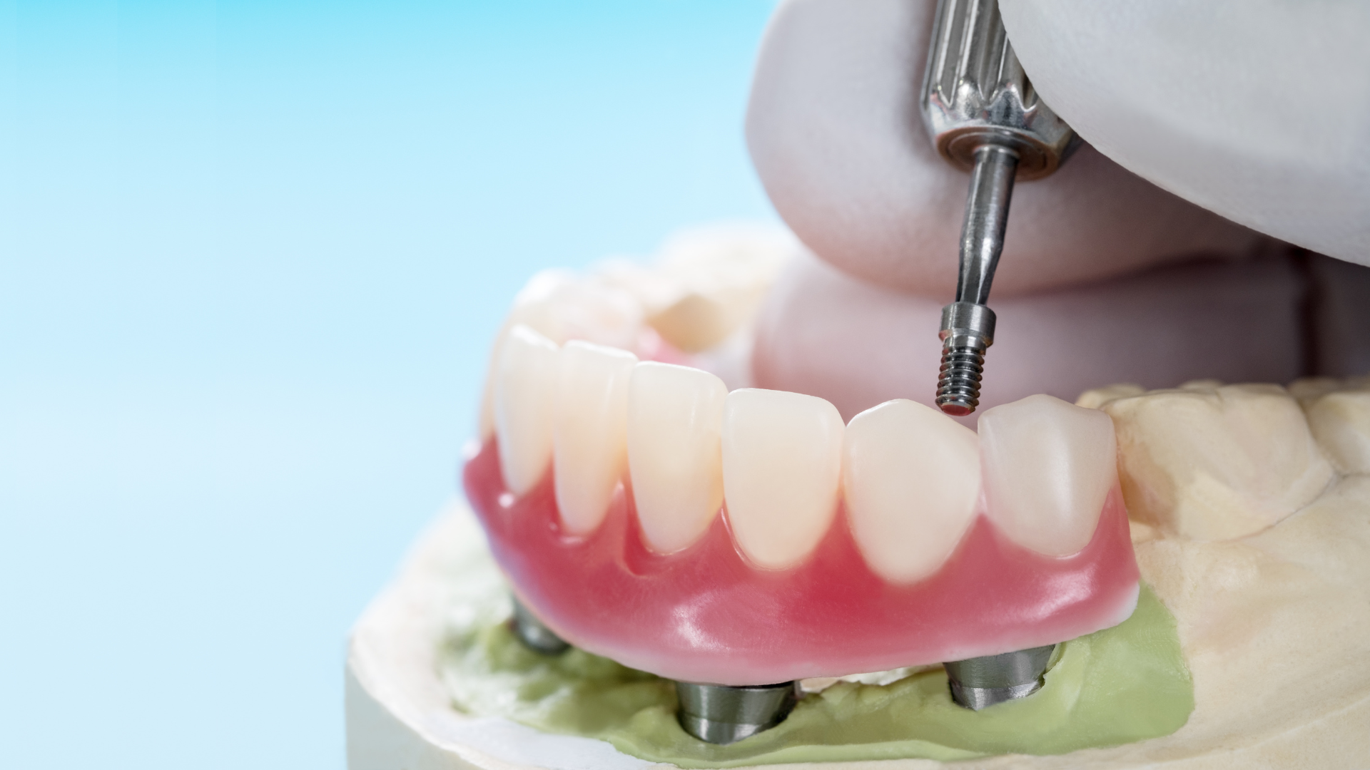 https://www.starlitedental.com/wp-content/uploads/2025/04/all-on-4.webp