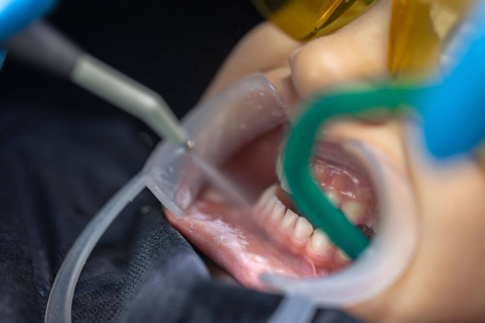 image of a patient during a dental cleaning