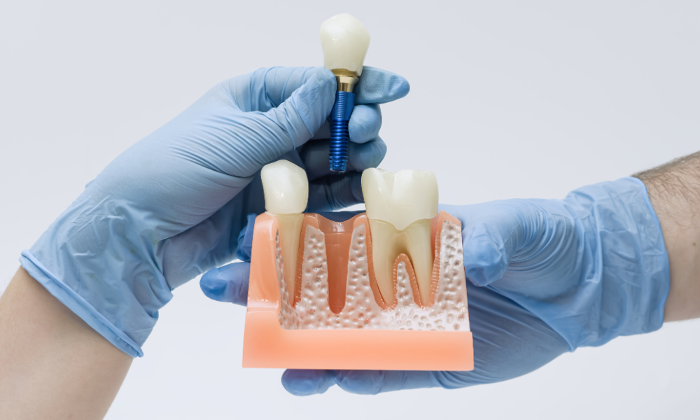 dental implant model showing single tooth implant placement